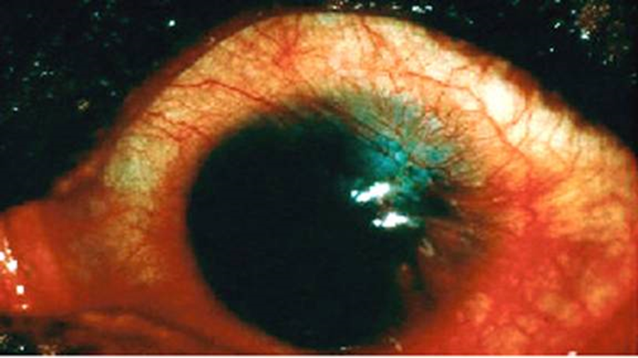 Longer term complication of untreated eye allergy