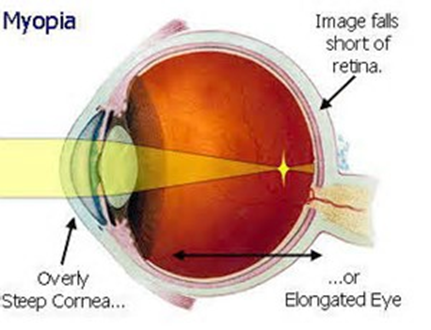eye: Myopia explained